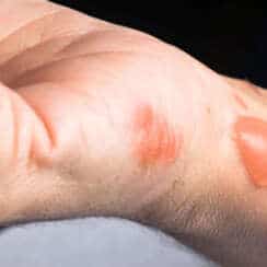5 Must know First aid measures for Domestic Burn Injuries