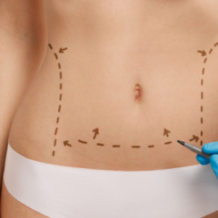 What are the benefits of Tummy Tuck Surgery?